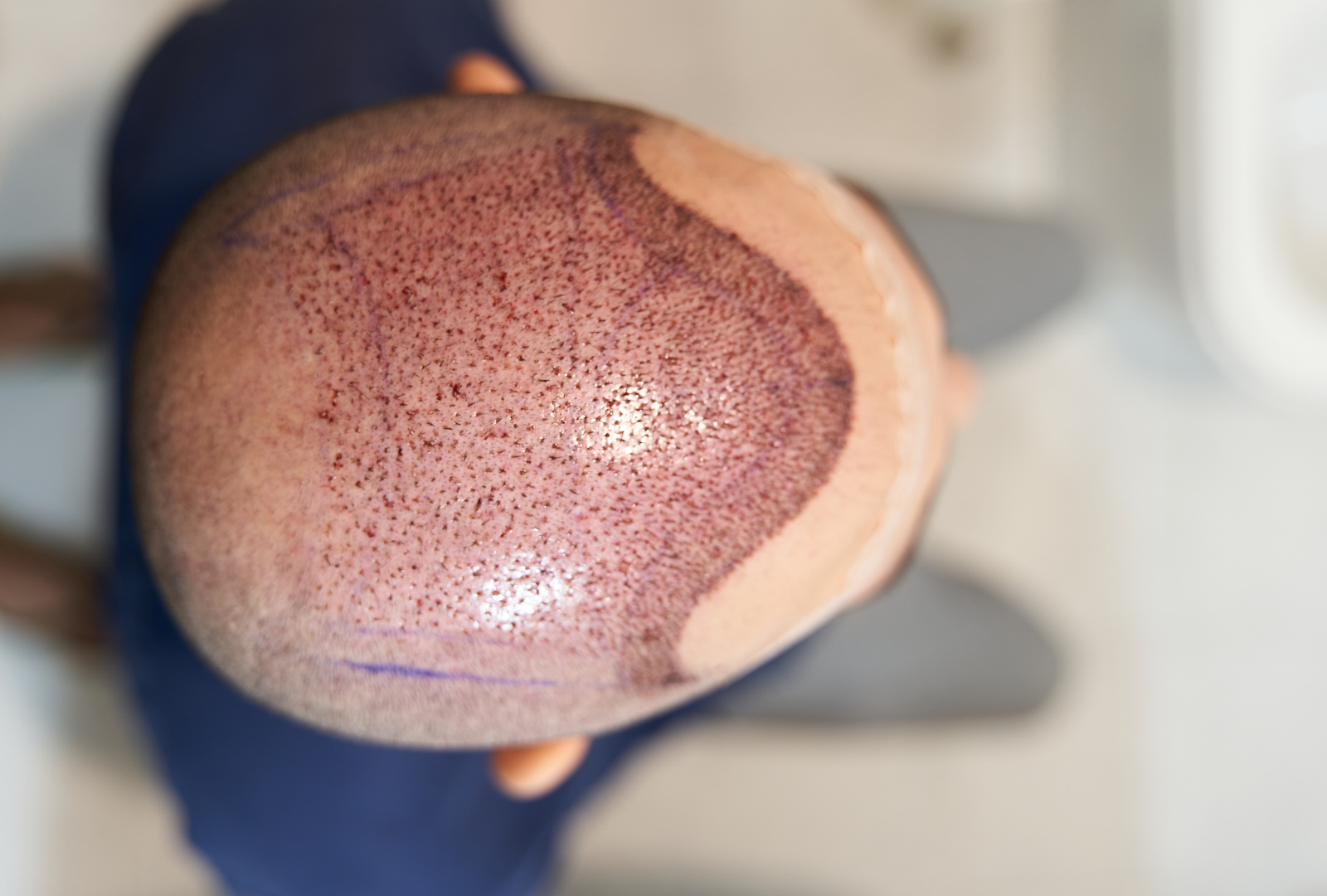 Is Turkey Good for Hair Transplants?